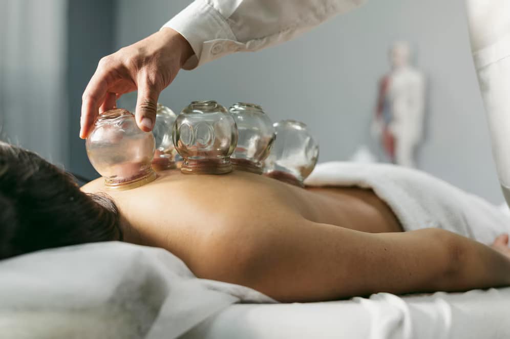 Cupping Therapy in Edmonton