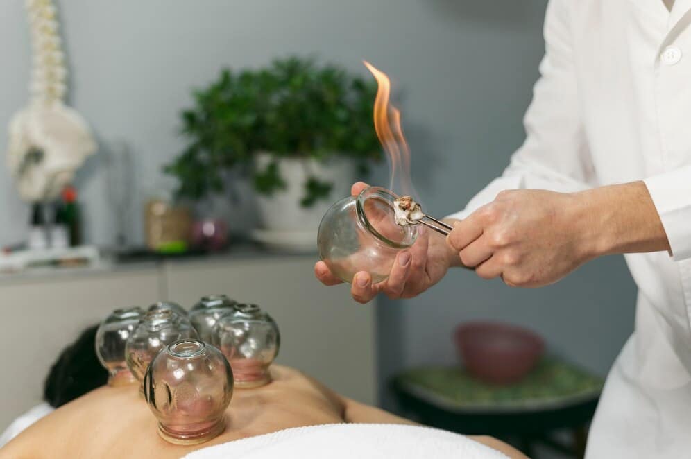 Cupping Therapy in Edmonton